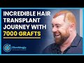 Incredible hair transplant journey with 7000 grafts