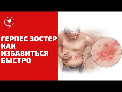 герпес зостер опоясывающий лишай как избавиться быстро 🔴 Проверено 100%