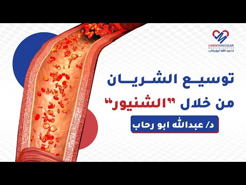 توسيع الشريان من خلال الشنيور د عبد الله ابو رحاب