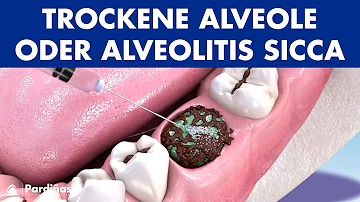 Kann eine trockene Alveole von selbst?