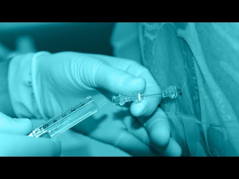 Vídeo: Diferencia Entre Anestesia Local Y General