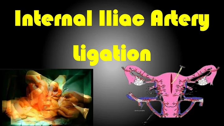 Internal Iliac Artery Ligation / Internal Iliac artery Ligation Procedure