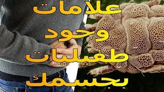 علامات تخبرك أن جسمك به طفيليات | الموسوعة العلمية