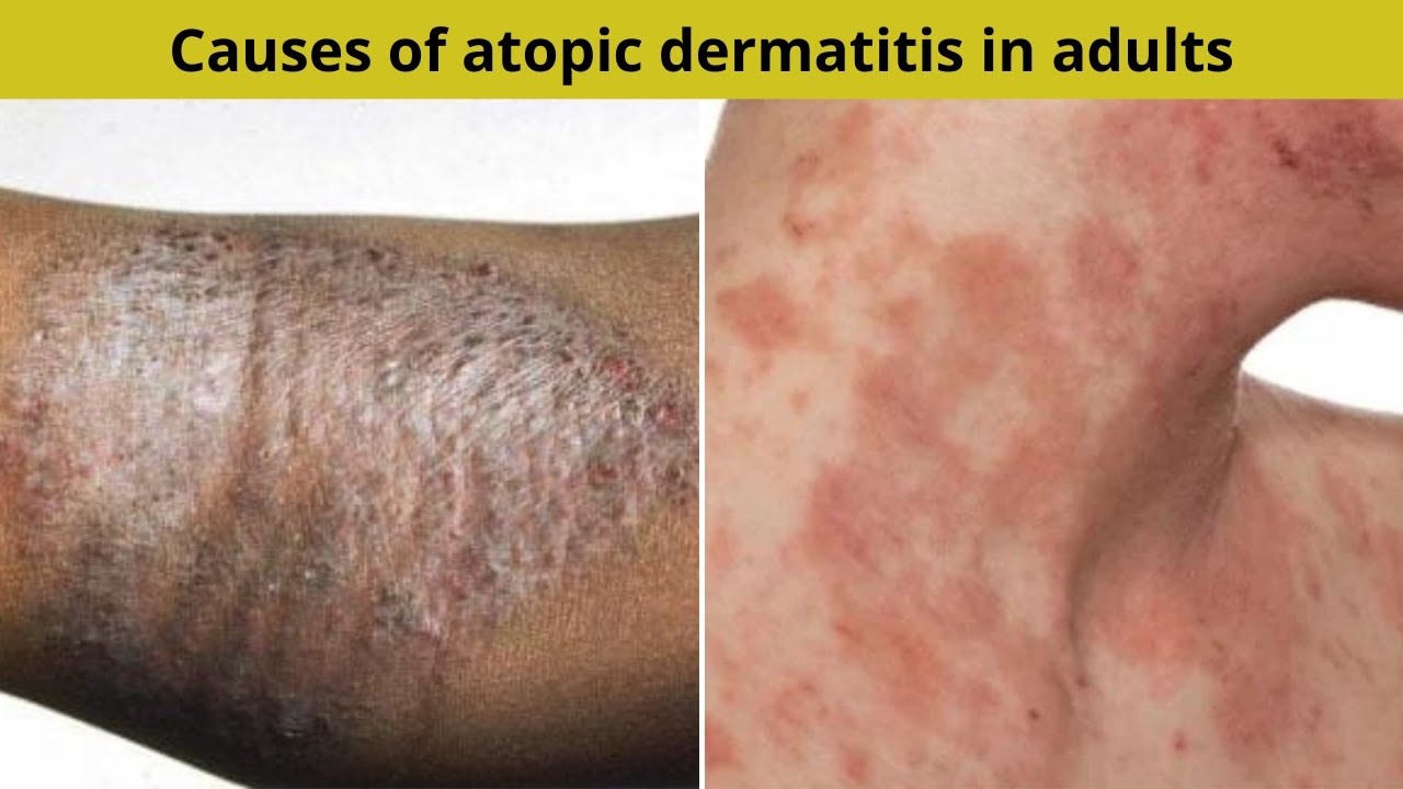 Causes of atopic dermatitis in adults | Nuse Healthy - YouTube