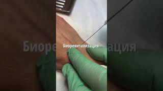 Биоревитализация. Канюльная техника