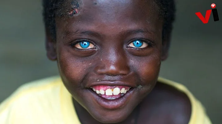 5 Stunning People With Waardenburg Syndrome