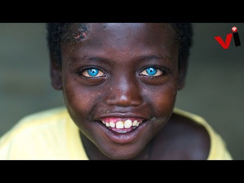 5 Stunning People With Waardenburg Syndrome