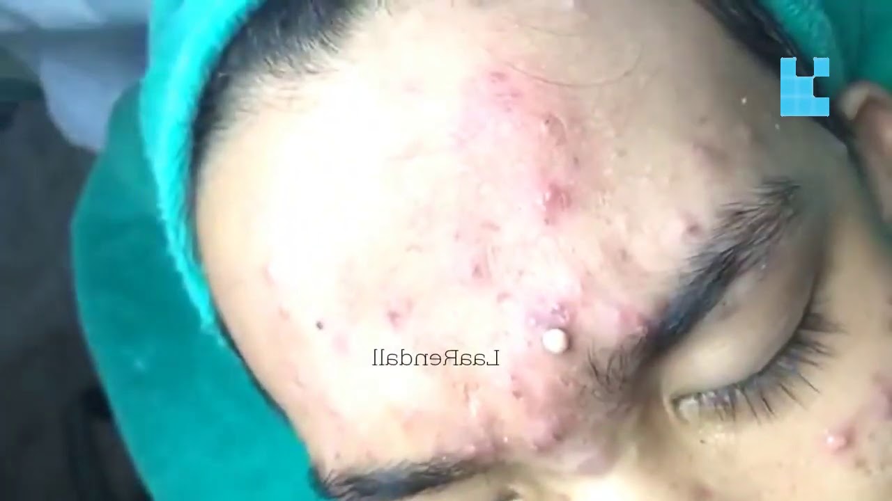 Blackheads And Milia Big Cystic Acne Blackheads Extraction Whiteheads