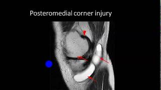 MRI OF KNEE SOFT TISSUE INJURIES