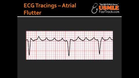 ECG Tracings -- Atrial Flutter