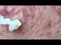 blackhead removal from nose/ old aged blackheads removal |