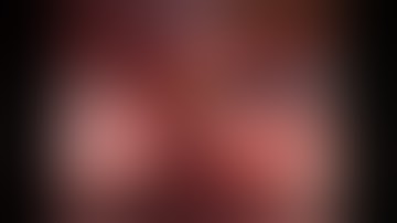 Robotic Excision of Intralobar Pulmonary Sequestration