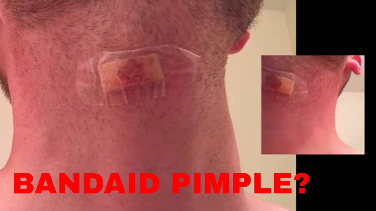 Bloody Pimple Abscess On My Neck *YouTube This Video Its So