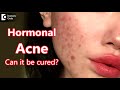 CAN HORMONAL ACNE BE CURED? | DR RASYA DIXIT | ACNE CARE TIPS