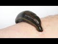 Leech therapy HoneyWolf Eesti