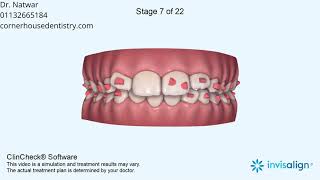 Deep Bite, Narrow Arches, Maxillary Midline Deviation, Mandibular Midline Deviation,