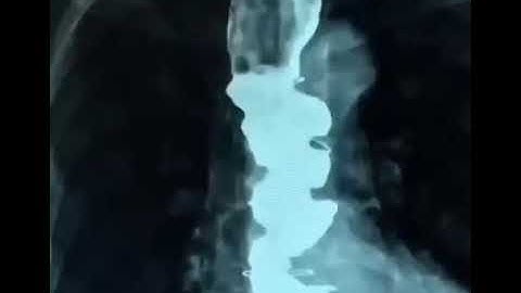 Diffuse/distal esophageal spasm (DOS)