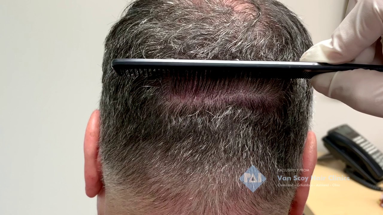 Vanscoy PAI MultiUnit Hair Grafting Hair Transplant Technology YouTube