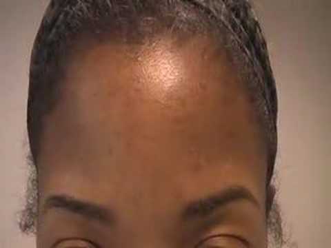 The Acne Practice  (mini bumps )
