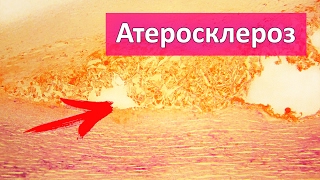 видео Атеросклероз аорты