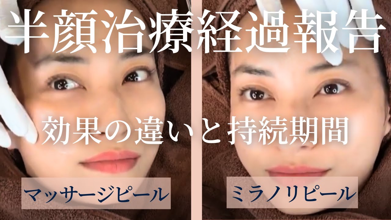 半顔治療経過をご報告！【マッサージピール＆ミラノリピール】
