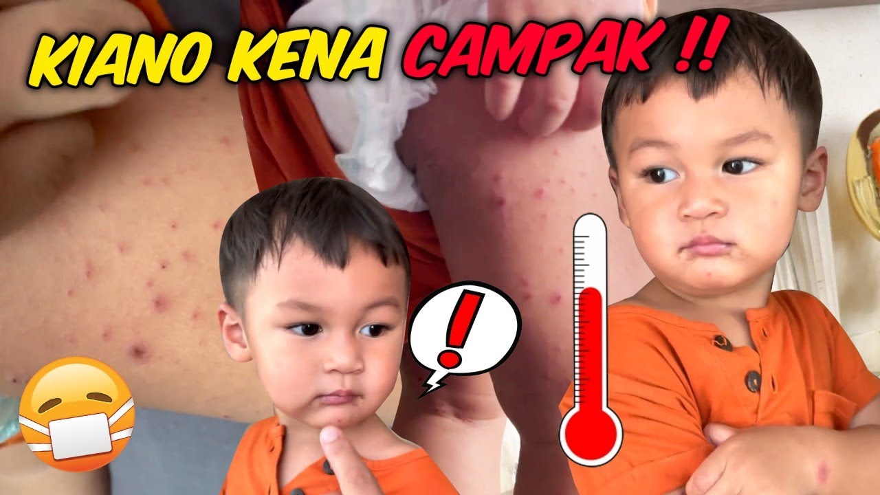 KAGET !!! SELURUH BADAN KIANO BERUBAH KAYA GINI !!! APAKAH KIANO KENA CAMPAK AUNTY UNCLE ???