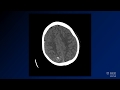 Neuroradiology board review lecture 1 case 12