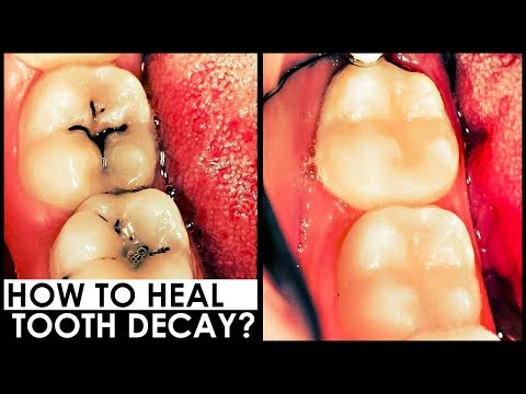 how-to-reverse-cavities-and-naturally-heal-tooth-decay-😍-how-to-heal-cavities-naturally