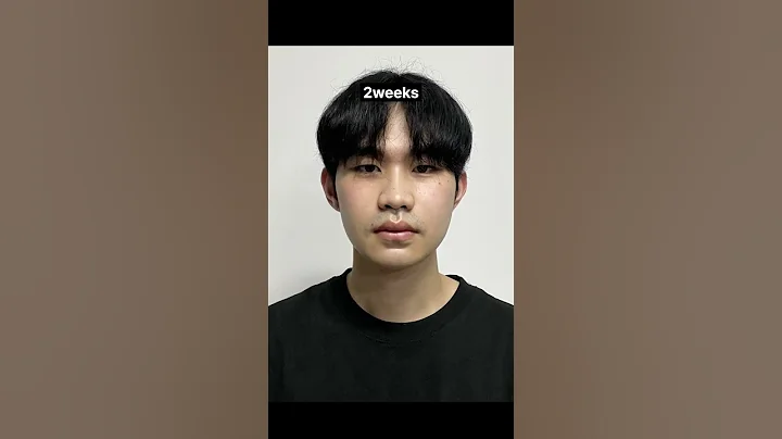 (12 months post op) Facial asymmetry, Double Jaw Surgery post op