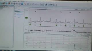 ВСР проба при электростимуляции шейного отдела. Программа анализа Полиспектр.