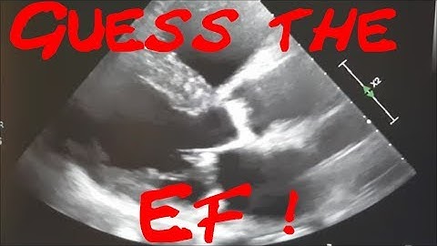 Guess the EF Part 2! Cardiology Echo Quiz/Case. Myocardial Infarction, Myocarditis, Cardiomyopathy?
