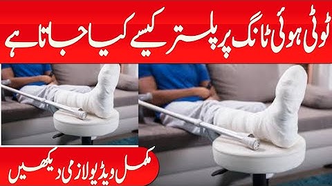 How to Apply a Below Knee Cast Using Plaster of Paris |how to apply plaster of Paris on leg |alitv4k