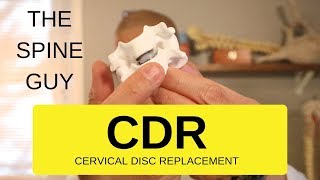 CERVICAL STENOSIS RADICULOPATHY  PART 6  CERVICAL DISC REPLACEMENT
