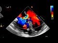 Atrial Septal Defect Primum Echocardiography