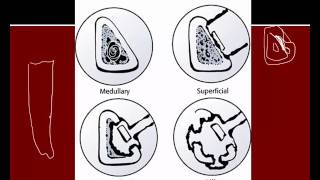 Chronic osteomyelitis