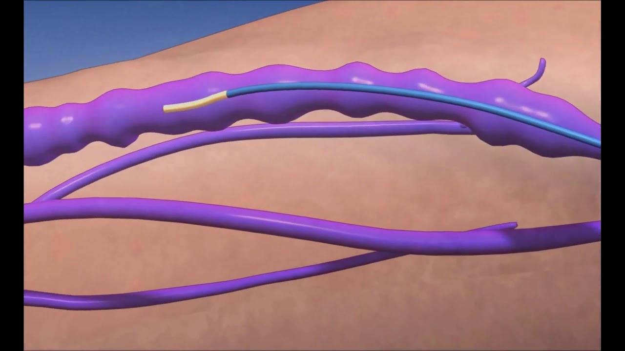 Лазерное удаление вен (Эндоваскулярная лазерная коагуляция вен) - YouTube