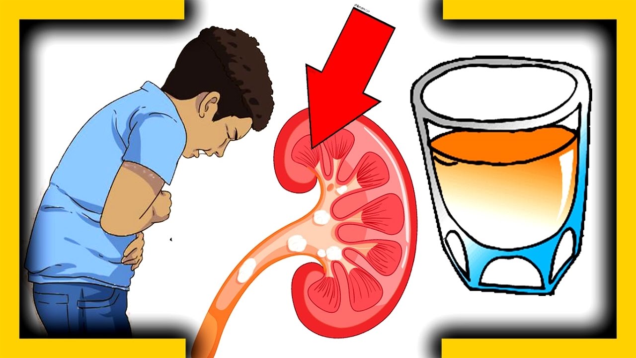 This Natural Drink Will “BREAK” Your Kidney Stones In Only Seven Days