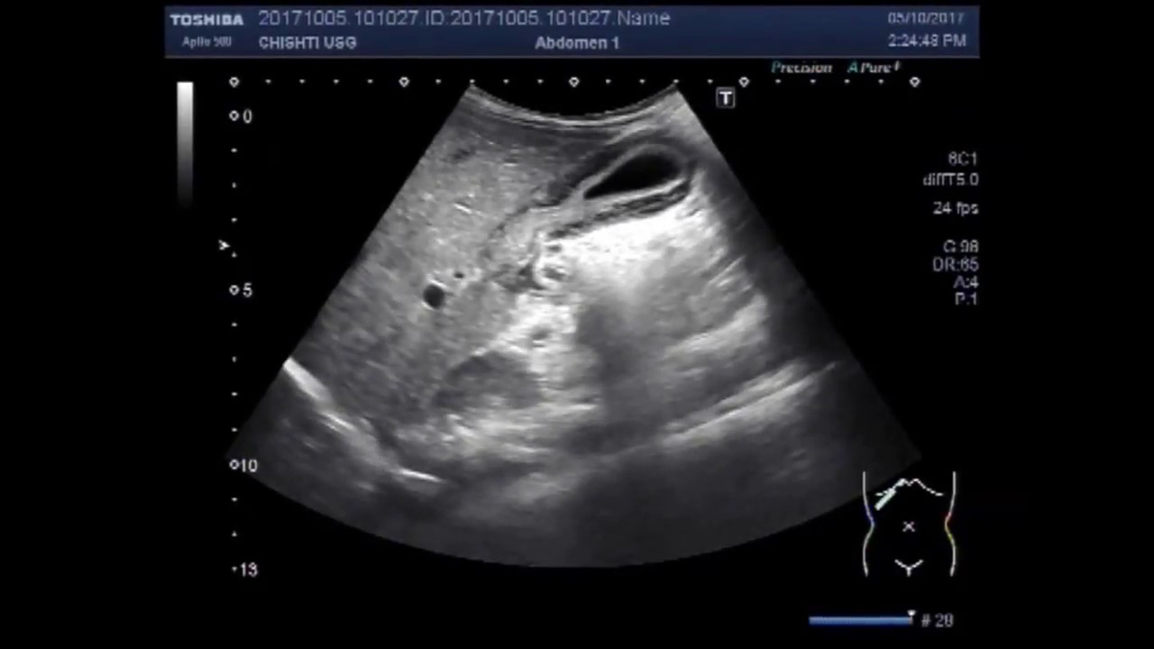 Ultrasound Video showing gall bladder wall thickness in a patient of