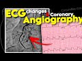 ECG changes in Myocardial Infarction and Coronary Angiography | Daily Cardiology
