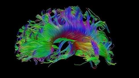 Dti-tractography-normal-corpus-callosum.ogv.480p