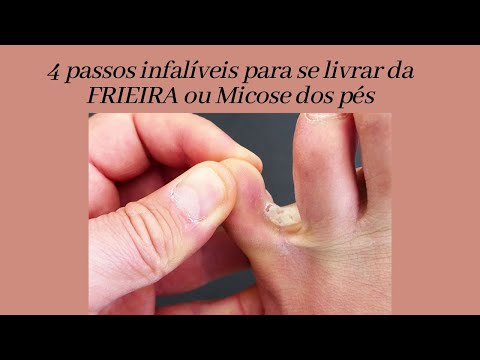 Vídeo: Como saber se você tem micose: 10 etapas (com fotos)