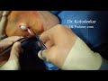 Cyst on the bottom of the foot surgically removed by a podiatrist  foot surgeon in orange county