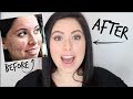 My Acne Story: How I Cleared my Skin &amp; Favourite Products!