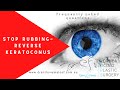 FAQ - Stop rubbing - Reverse Keratoconus - Dr Anthony Maloof Sydney