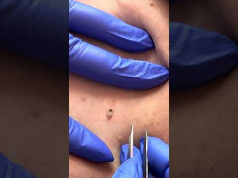 Upper thigh blackhead extraction at Southern Sugaring