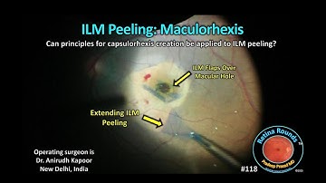 RetinaRounds™ 118: ILM Peeling: Maculorhexis