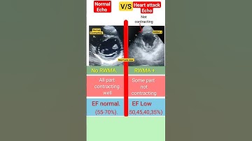 Difference between normal and heart attack Echo #echo #heartattack #shorts