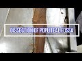 Dissection of Popliteal Fossa