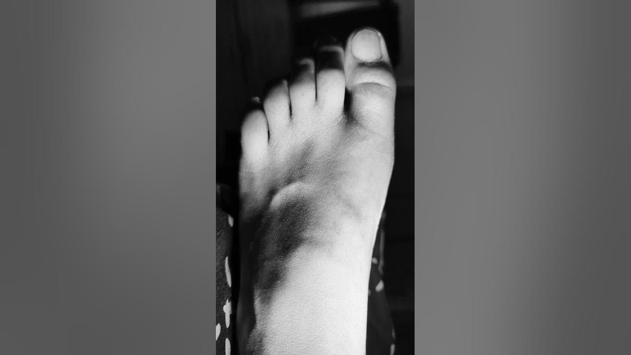 myokymia-and-involuntary-toe-movements-cramp-fasciculation-syndrome