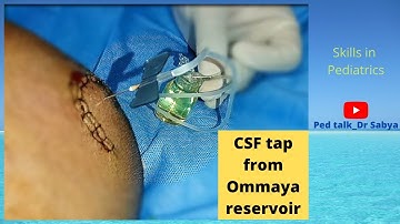 CSF tap procedure from Ommaya reservoir/ Ommaya tap/ decreasing RICT in Hydrocephalus